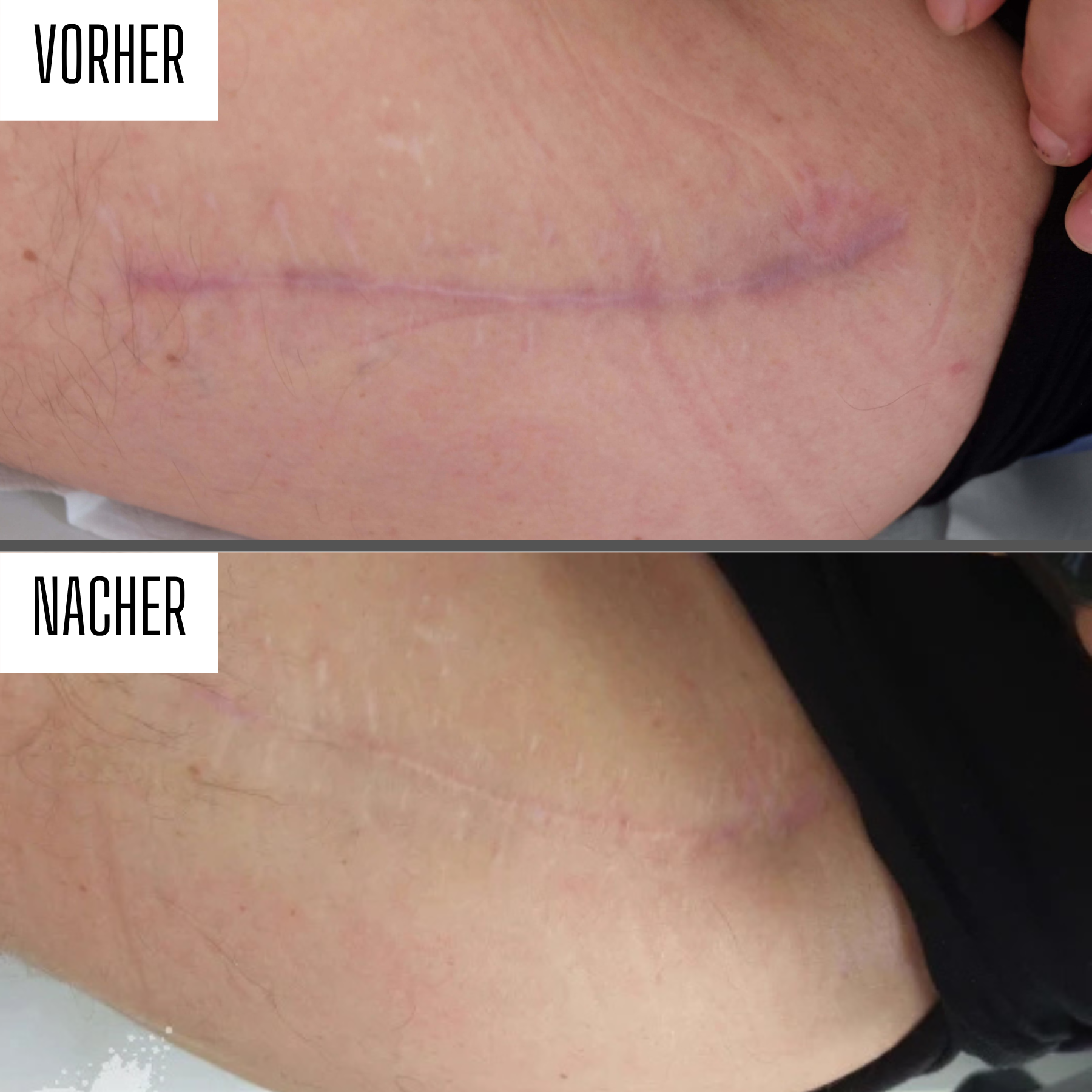 Silikonpflaster gegen Narben & Falten