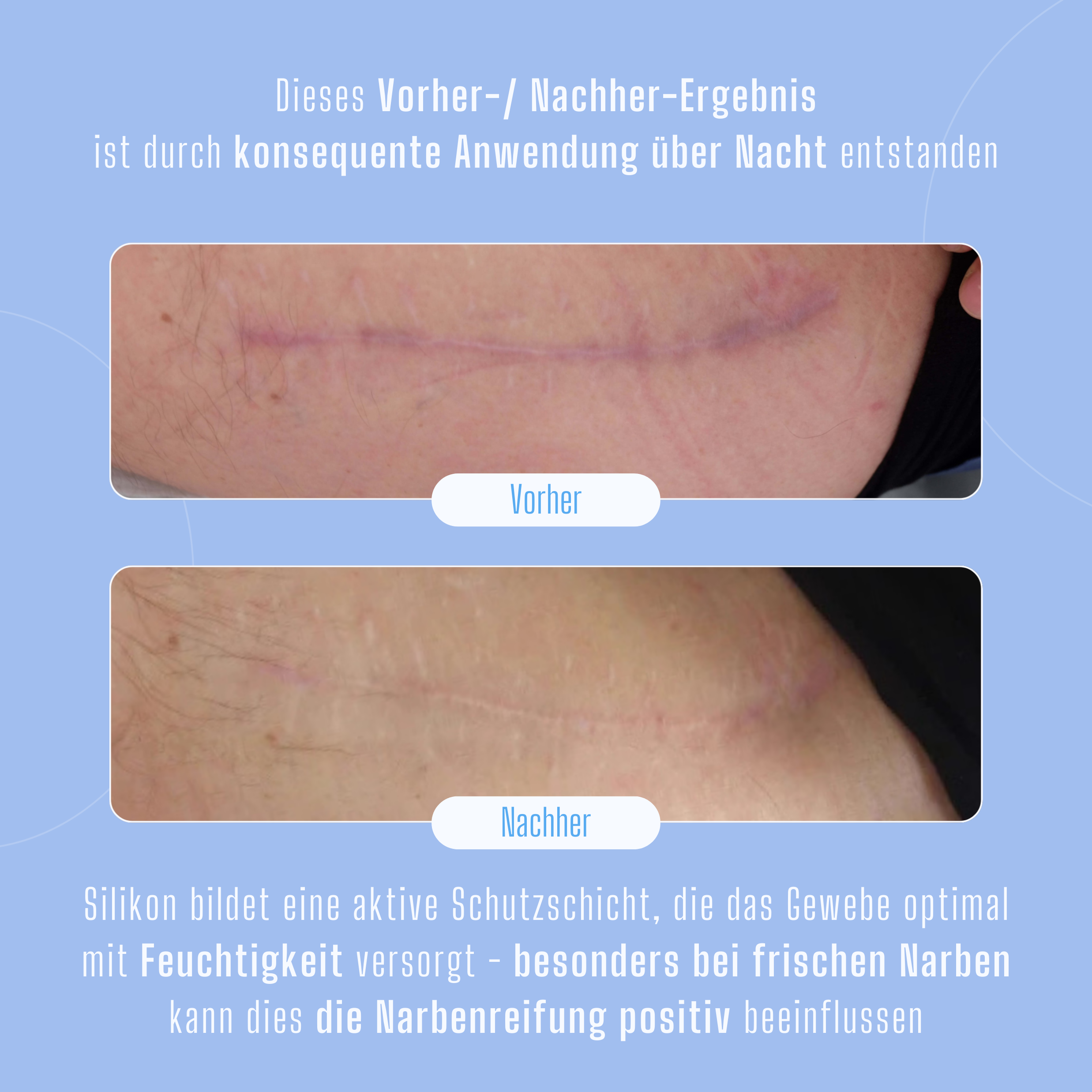 Silikonpflaster gegen Falten & Narben