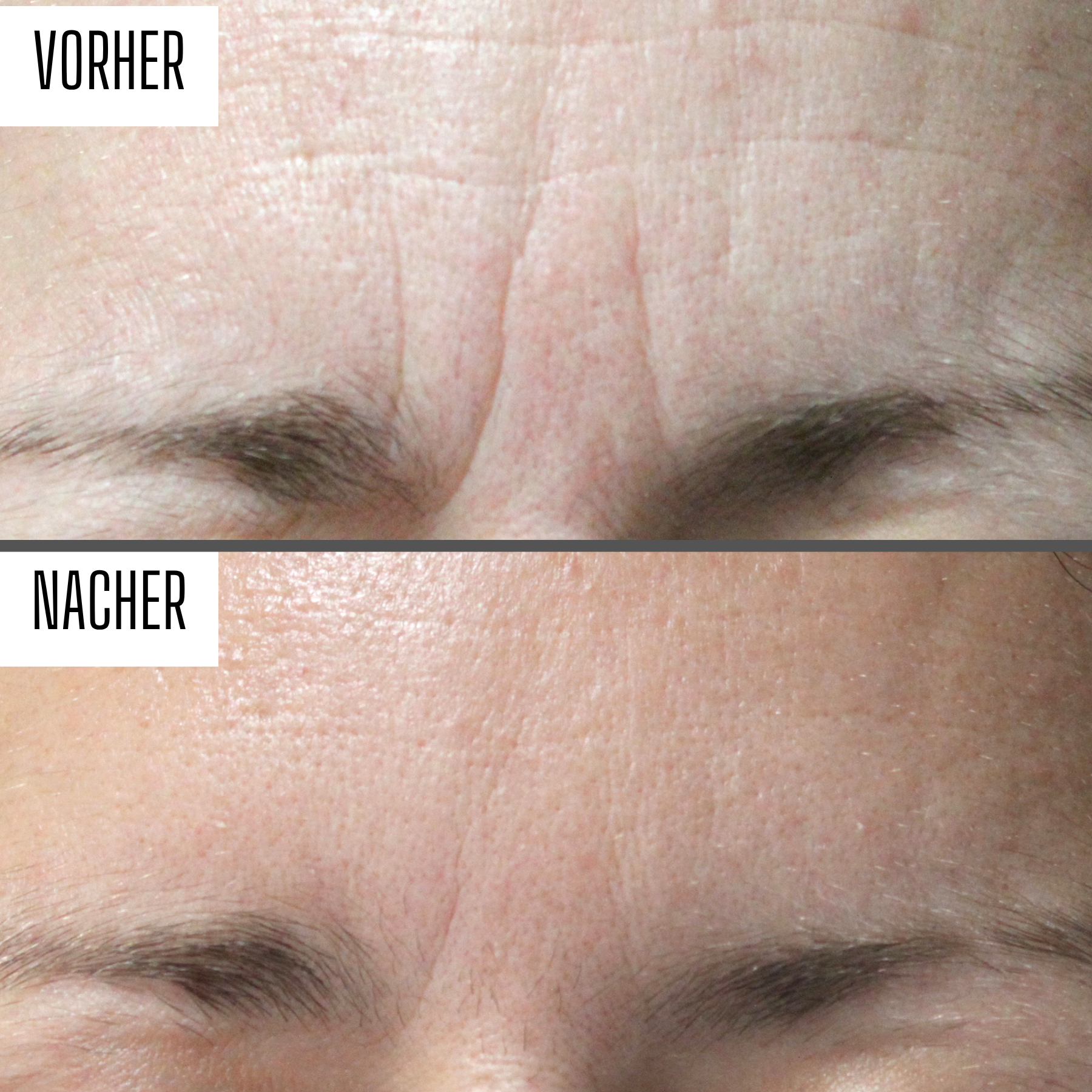 Silikonpflaster gegen Narben & Falten